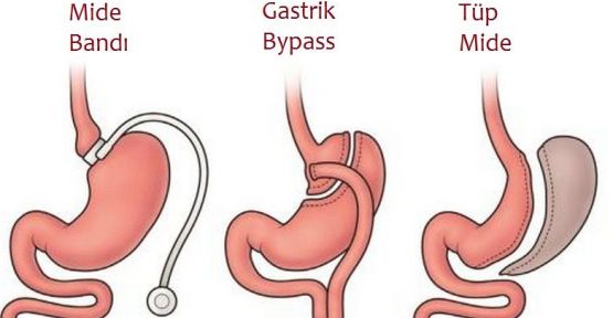 MİDE AMELİYATINDAN SONRA DİKİŞİ PATLAYAN GENÇ HAYATINI KAYBETTİ